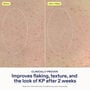 Skinfix KP PsO Smoothing Body Treatment, 5.07 fl. oz., , large image number 3