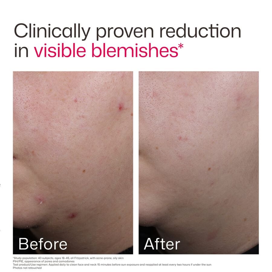 EltaMD UV Clear Blemish-Prone & Oil Balancing, SPF 50, 1.7 oz., , large image number 6