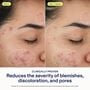 SkinFix 2% BHA Cleanser, 5 fl. oz., , large image number 3